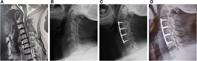 Treatment of three-level cervical spondylotic myelopathy using ACDF or a combination of ACDF and ACCF